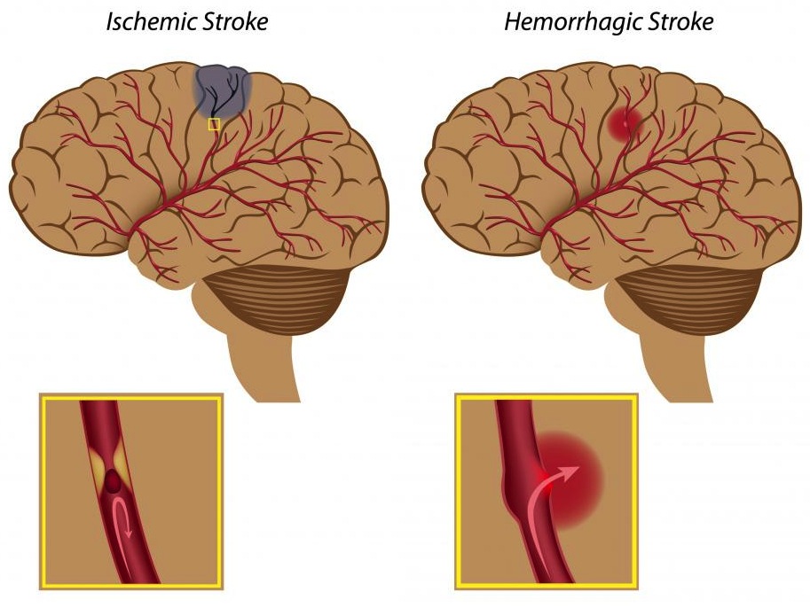 diagram-of-brain-strokes